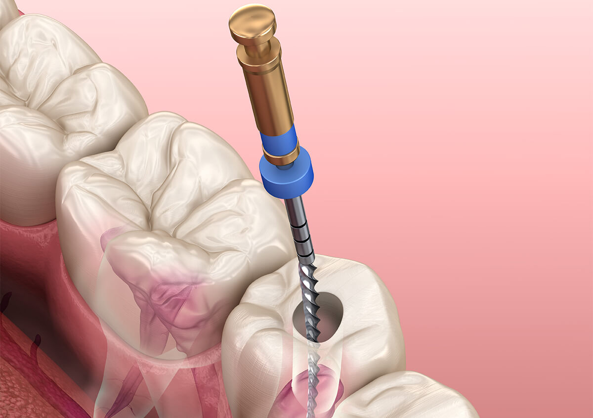 Signs You Need a Root Canal in Augusta GA Area